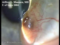 Conjunctival melanoma