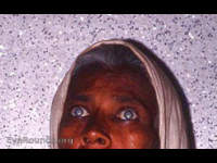 Bilateral mature senile cataract