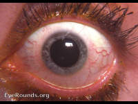 uveitis with iris atrophy and fixed, dilated pupil