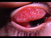 palpebral vernal conjunctivitis