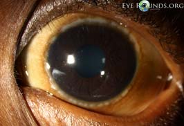 Limbal vernal keratoconjunctivitis