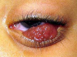 viral papilloma