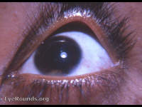 pages/vitiligo-iridis.html