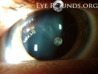 Vitreous Cyst