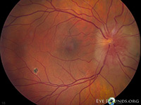 Vitreous Cyst