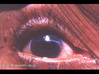 cataract surgery complications: a von Graefe knife incision that went astray. In spite of its improper placement and the use of no sutures, the wound healed perfectly.