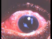 Needled aftercataract