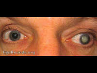white cataract from trauma