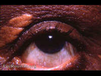xanthelasma