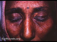 classic xanthelasma