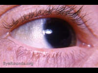 xerosis conjuntivae