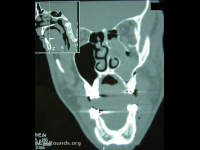 zygomatic maxillary complex (ZMC) tripod fracture