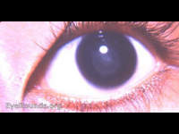 zonular cataract / lamellar cataract
