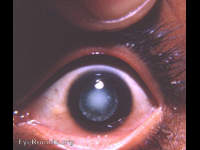 zonular/ lamellar congenital cataract with associated coronary cataract
