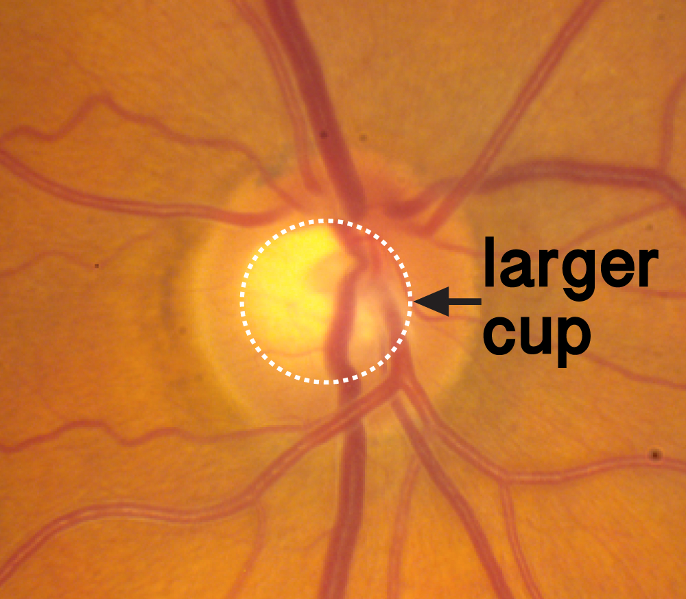 Ch 1 Glaucoma Optic Nerve Disease A Patient s Guide To Glaucoma