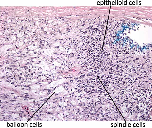 Higher power view of the lesion demonstrates infiltration of iris root and ciliary body with spindle cells and epithelioid cells. Balloon cells with foamy cytoplasm are also present.