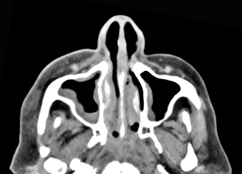 figure 3. Pansinusitis with heterogeneous mucosal thickening is seen in the bilateral maxillary sinuses, the nasal cavity, the ethmoid sinuses, the sphenoid sinuses, and the right frontal sinus. No bony erosion is evident. There is soft tissue swelling or the preseptal tissue on the right. 
