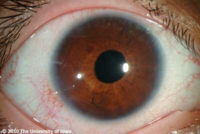 Figure Three:  Centered iris-sutured intraocular lens several years after surgery