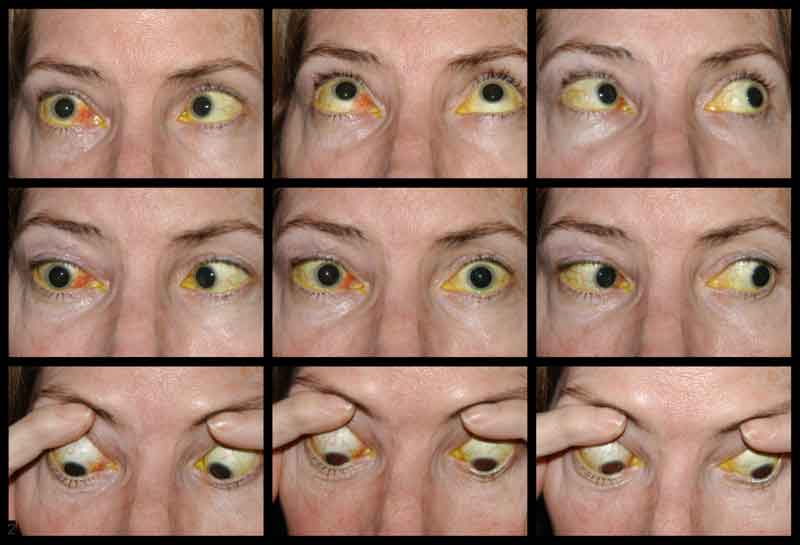 Figure 2: Motility photos: Note the abduction deficit in the right eye. 