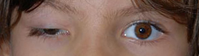 Note the ptosis of the right upper eyelid