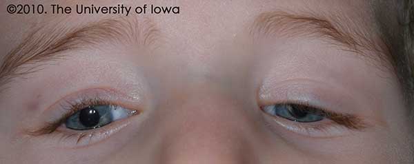 Figure 6. congenital fibrosis of the extraocular muscles and associated bilateral ptosis