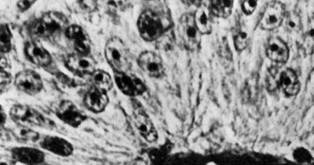Figure 5D: Fascicular cells showing a palisading pattern above vessel