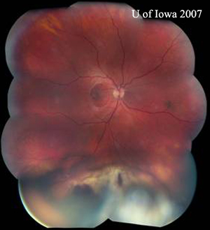 Figure 2: Montage image of fundus, OD. Epiretinal membrane is visualized in the macula. The mass is seen inferiorly. Small retinal hemorrhage overlies the mass posteriorly.
