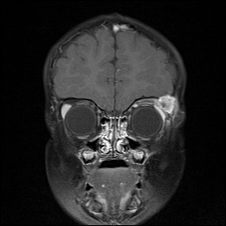 Figure 3. T1 post-contrast coronal MRI image demonstrate an enhancing mass in the superotemporal aspect of the left orbit. Note that the homogenous soft tissue characteristics of the lesion are well-defined with this imaging modality.