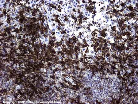 Figure 7: This 100x view demonstrates histiocytes present in the tissue, strongly positive with CD1a (brown), consistent with Langerhans cell histiocytosis 