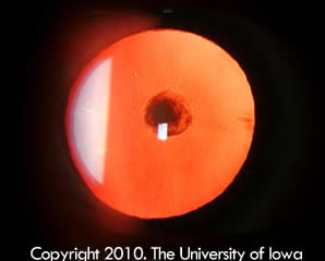 Red reflex showing posterior polar cataract of the right eye 