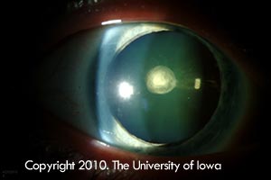 Slit lamp photo of the posterior polar cataract