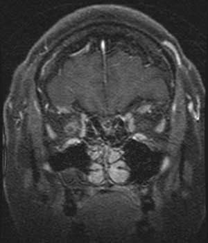 Optic nerve sheath meningioma (coronal)