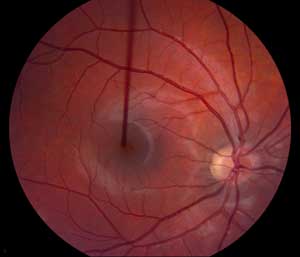 Right Fundus photo with normal optic nerve with peripapillary atrophy