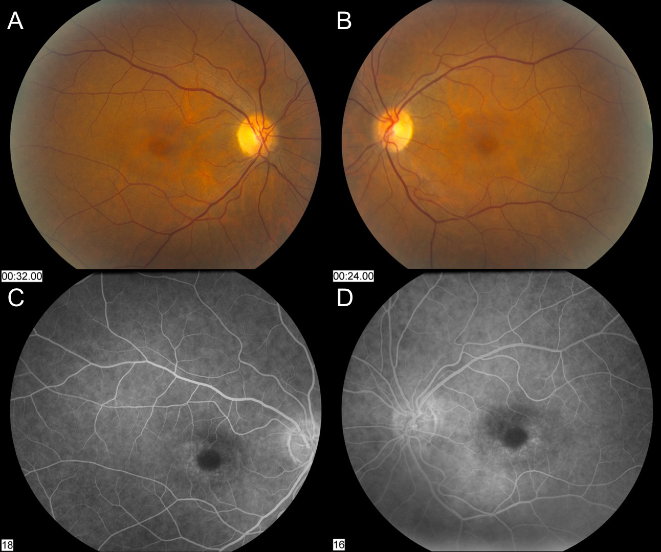 Hydroxychloroquine Plaquenil Toxicity And Recommendations For Screening