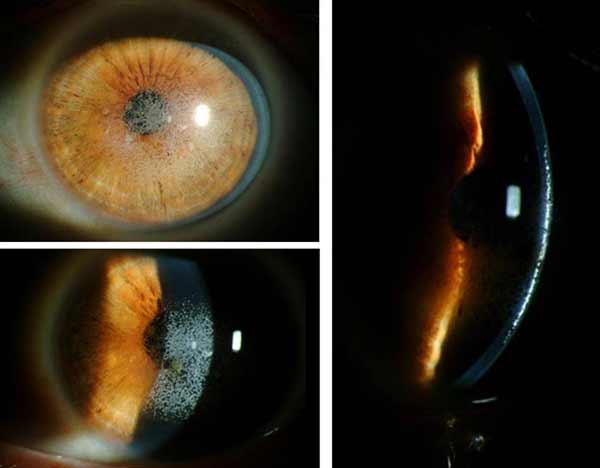 Slit lamp photos of left eye demonstrating granular white opacities located at the level of the LASIK flap interface