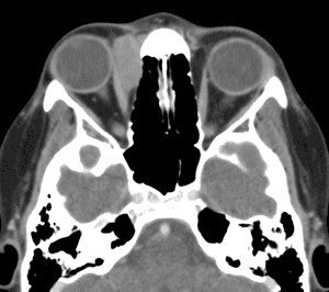 Orbital CT Scan