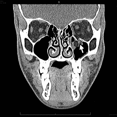 Figure 2b shows a more posterior aspect of the orbital floor fracture with the inferior rectus muscle body completely herniated within the maxillary sinus