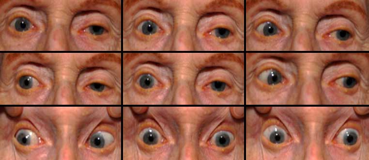 9 gazes, progressive supranuclear palsy