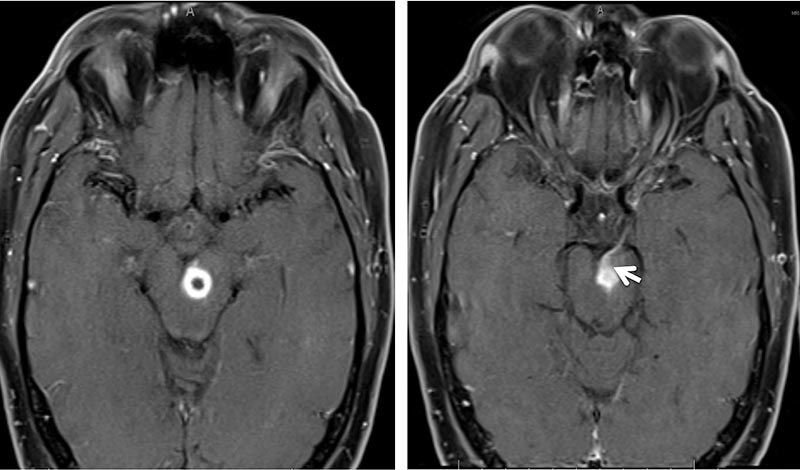 Post-gadolinium axial t1-weighted MRI, see caption for details