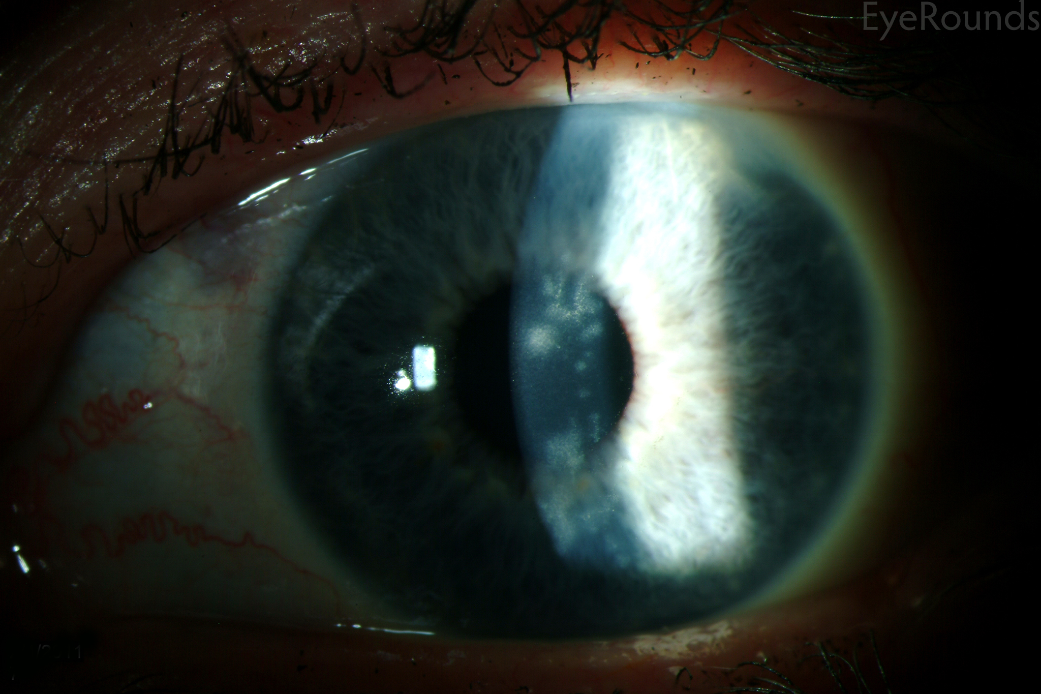 herpes simplex keratitis