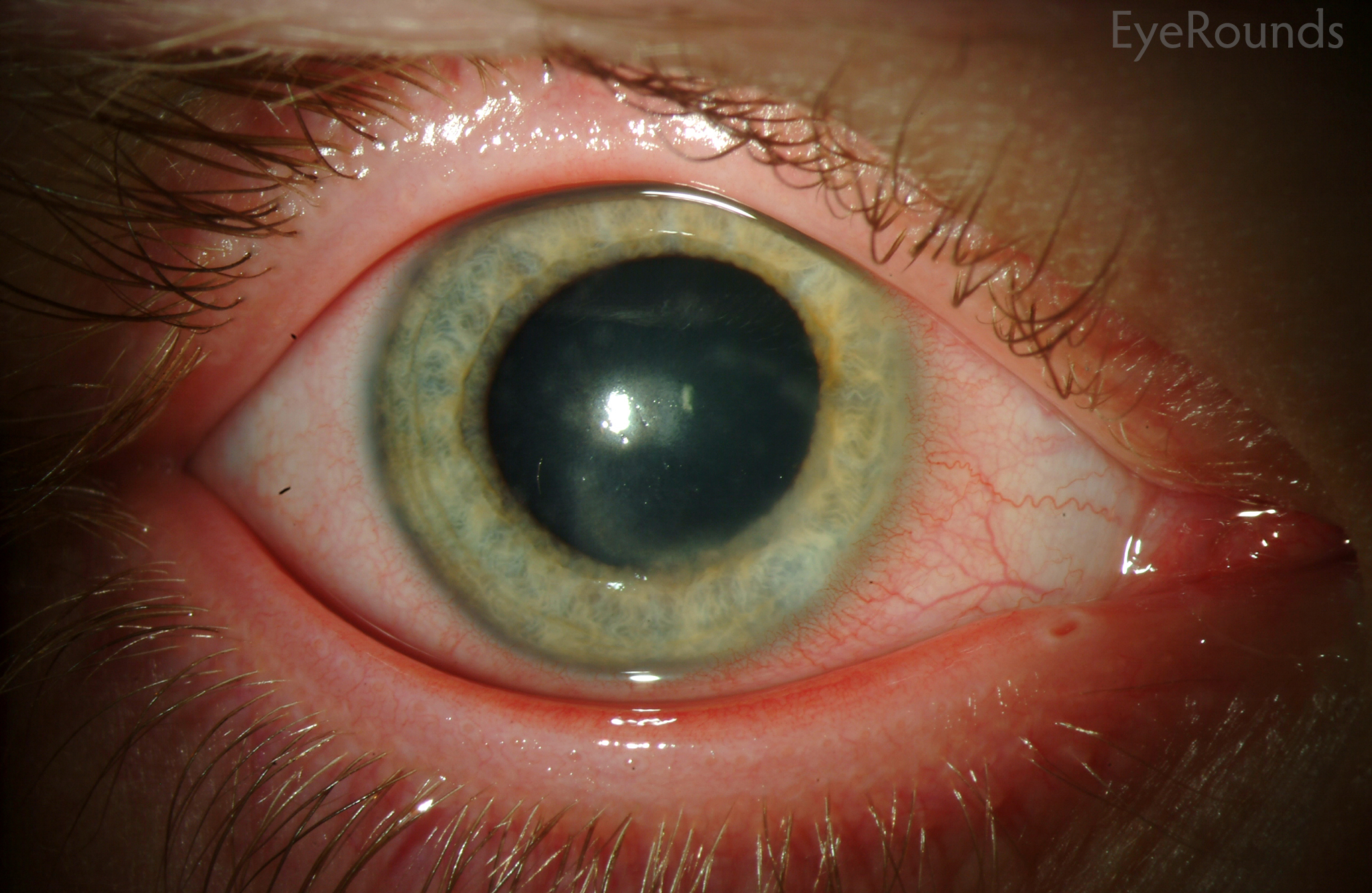 herpes simplex keratitis