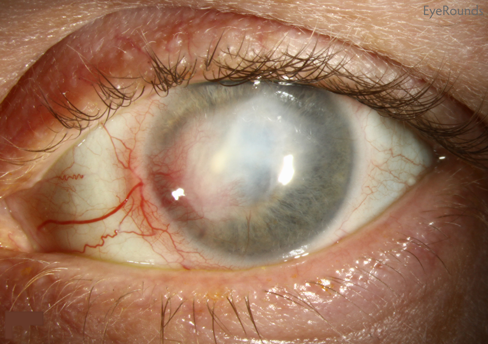 stromal keratitis