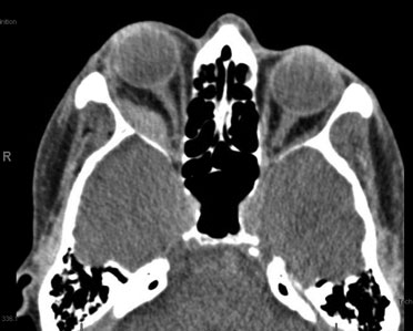 computed tomography (CT) of the orbit without contrast demonstrating a right lateral extraconal well-demarcated mass and proptosis