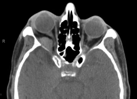 Soft tissue CT of the orbit without contrast demonstrating right lateral extraconal mass with increased buckling of the optic nerve