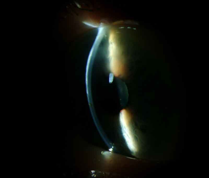 Salzmann Nodular corneal degenertion