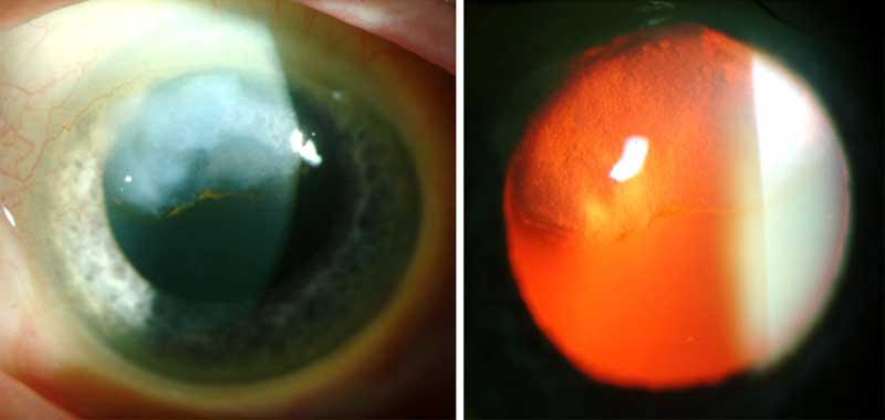 Slit lamp photo of the right eye of another patient with a superior Salzmann's nodule.