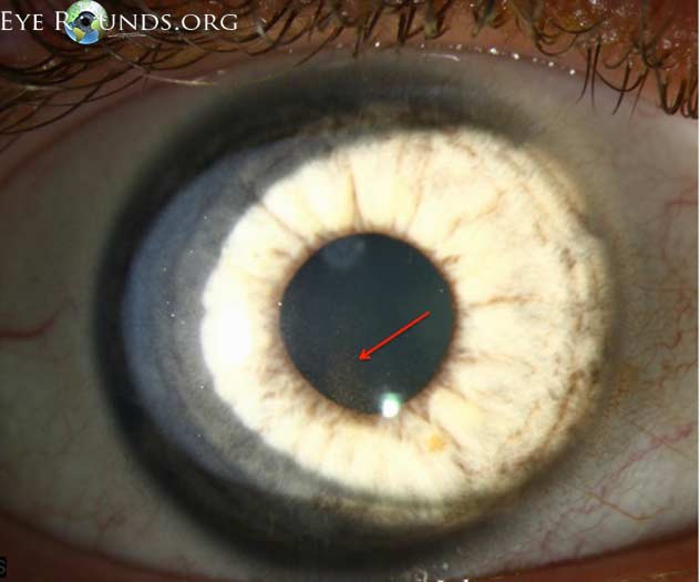 Slit lamp photograph showing a Krukenberg spindle visible on the corneal endothelium