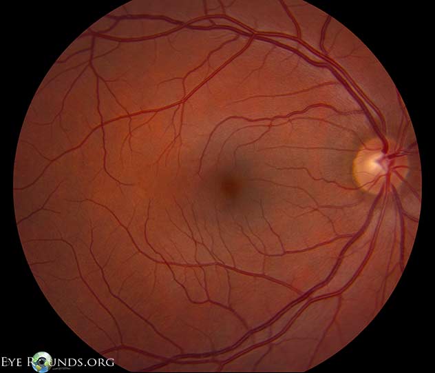 Fundus photographs showing asymmetric optic nerve head cupping