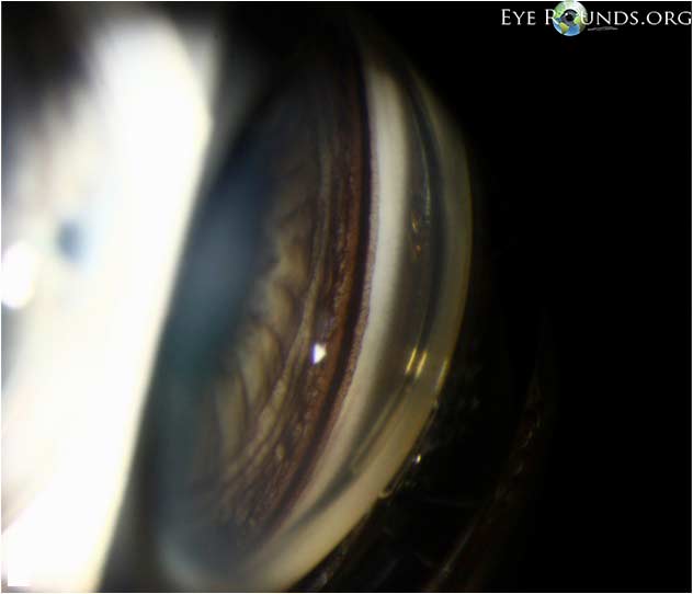 Gonioscopic photograph showing marked iris backbowing, a very deep anterior chamber, and heavy pigmentation of the trabecular meshwork