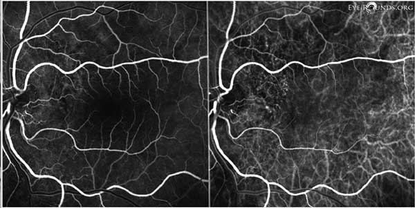 Figure 10: OS FFA (left) and ICG (right) showing subtle punctate areas of hyperfluorescence just temporal to the nerve, most consistent with polypoidal lesions. 